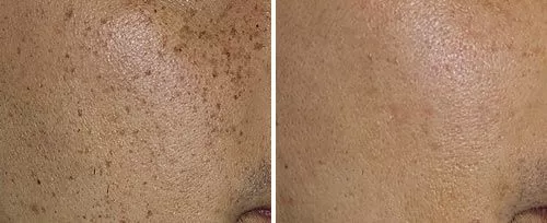 Flat-Moles-before-and-after.jpg